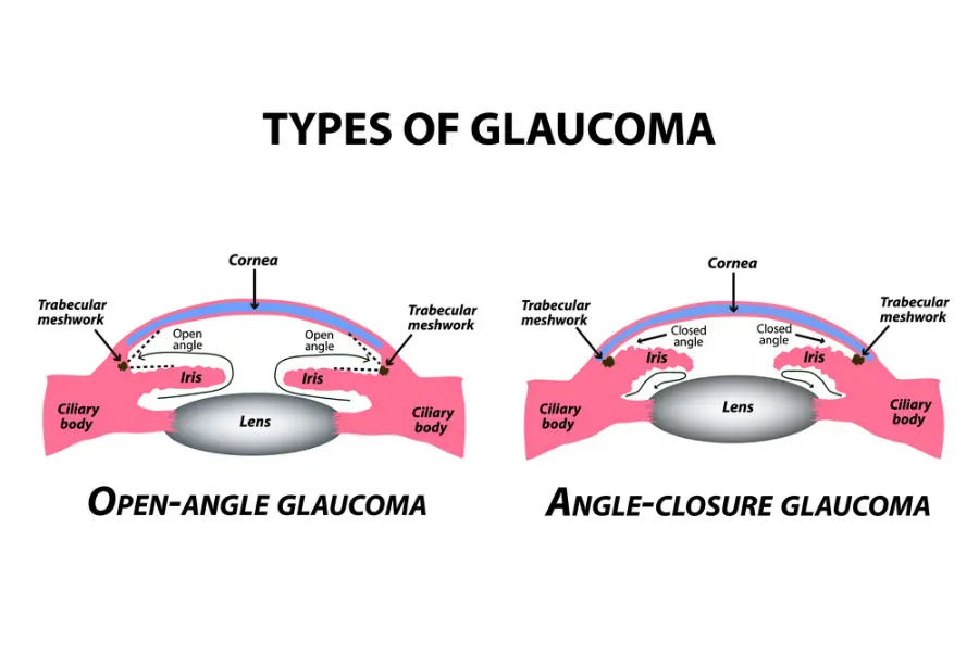 Open-angle glaucoma vs Closed-angle glaucoma