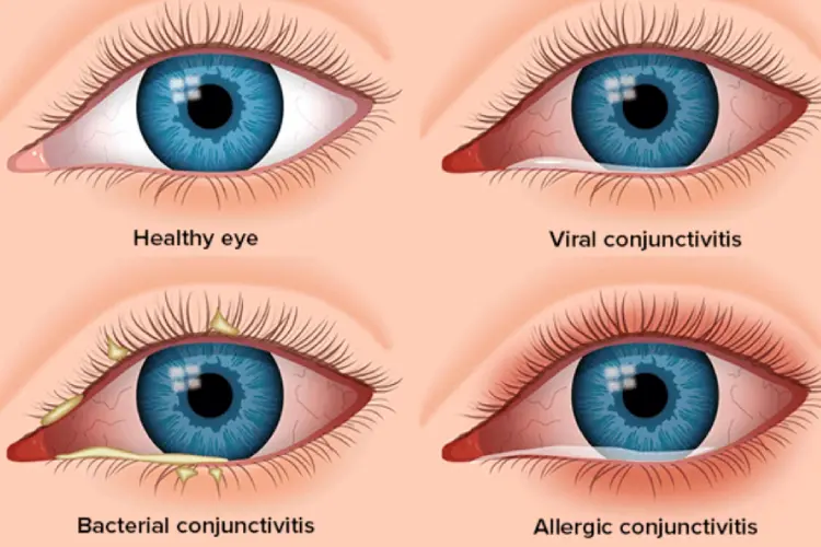 The Allergy-Eye Infection Connection Explained