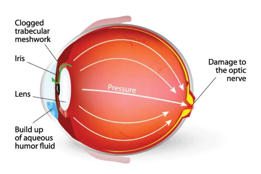 Pseudoexfoliation Syndrome Explained|Eye Doctor Chembur